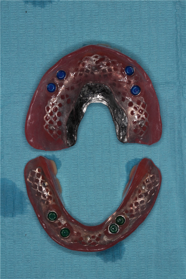 口腔科完成我院首例全口种植覆盖义齿修复术