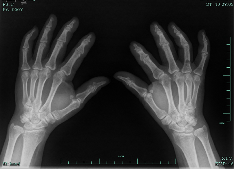 右环指内生软骨瘤1例